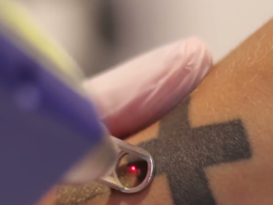Laser sendo aplicado sobre tatuagem durante sessão de remoção na Clínica da Barbe